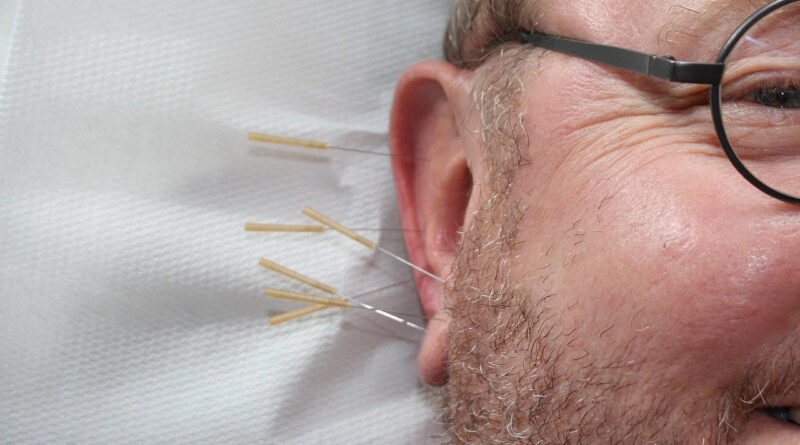 Was versteht man unter Ohrakupunktur?